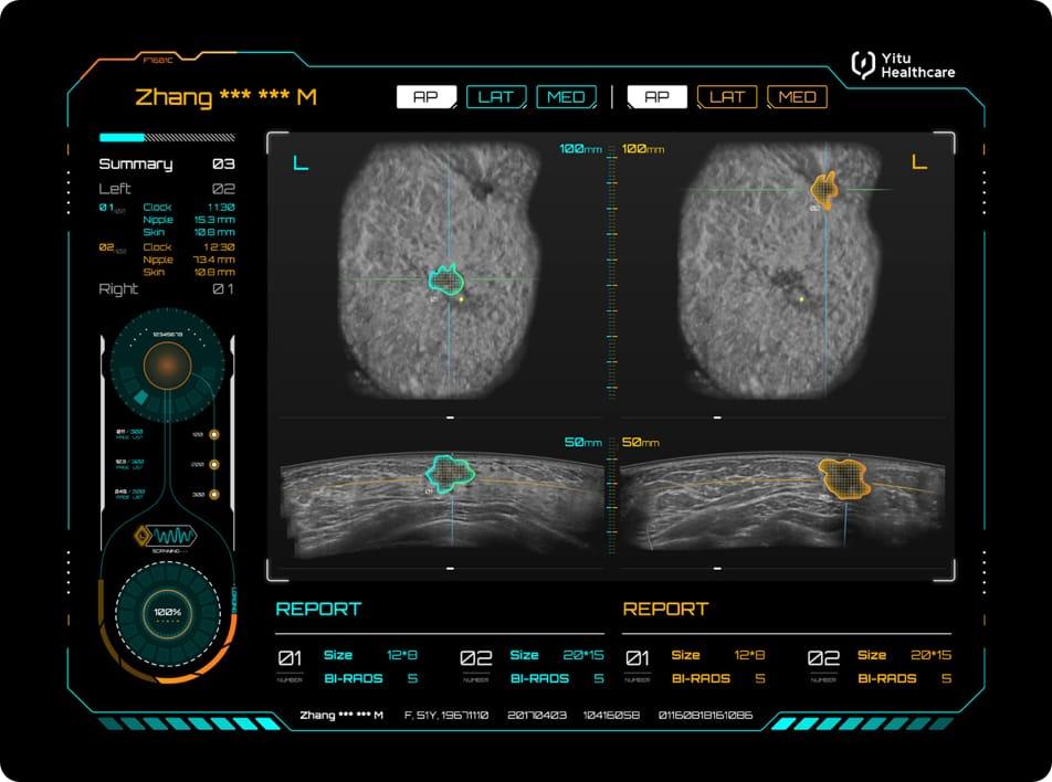 care.aiTM 乳腺超聲智能診斷系統(tǒng)